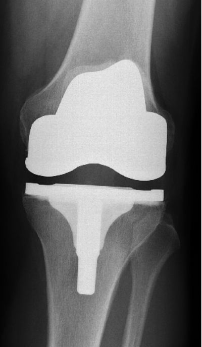 Smith & Nephew Genesis II (Implant 10)